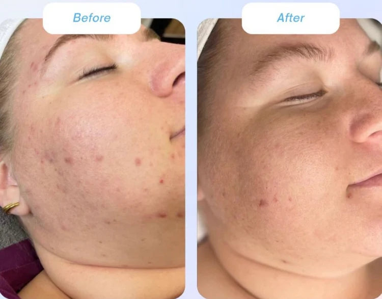 Trudermal Glow LED Light Therapy Face Mask