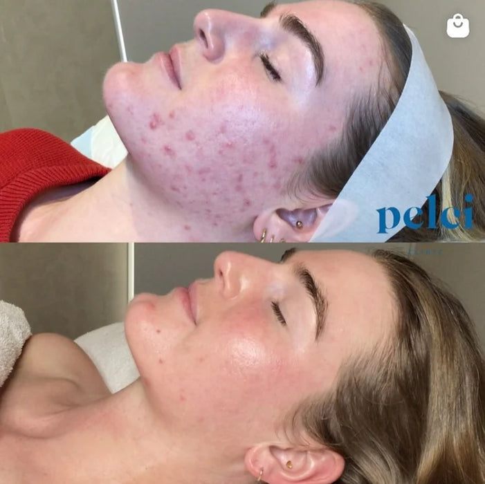 Trudermal Glow LED Light Therapy Face Mask